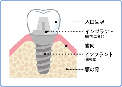 インプラントとは