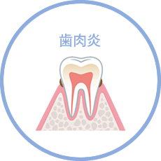 歯肉炎
