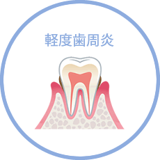 軽度歯周炎