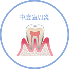 中度歯周炎