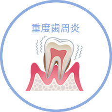 重度歯周炎